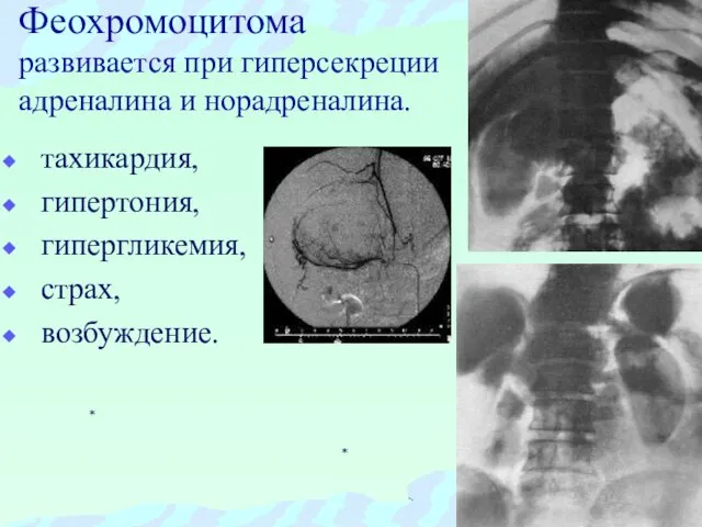 Феохромоцитома развивается при гиперсекреции адреналина и норадреналина. тахикардия, гипертония, гипергликемия, страх, возбуждение.