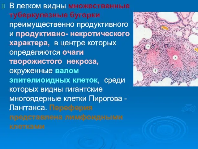 В легком видны множественные туберкулезные бугорки преимущественно продуктивного и продуктивно- некротического