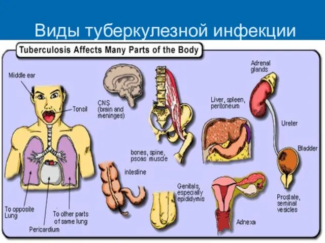 Виды туберкулезной инфекции