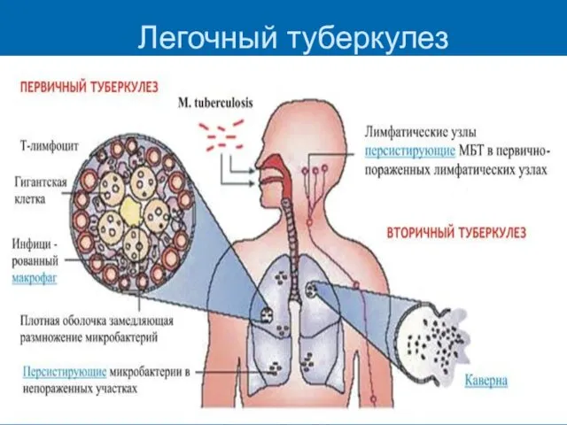 Легочный туберкулез