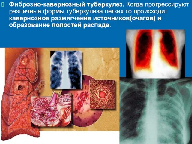 Фиброзно-кавернозный туберкулез. Когда прогрессируют различные формы туберкулеза легких то происходит кавернозное