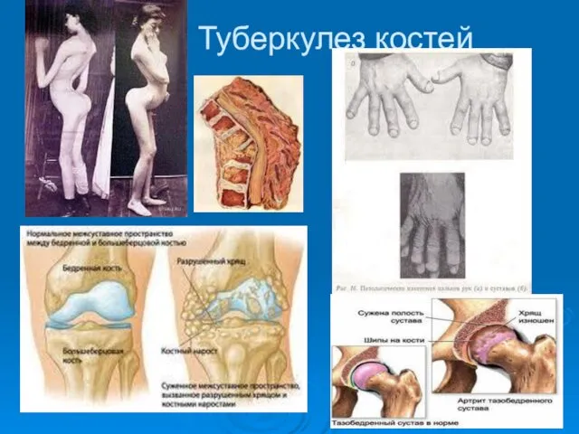 Туберкулез костей