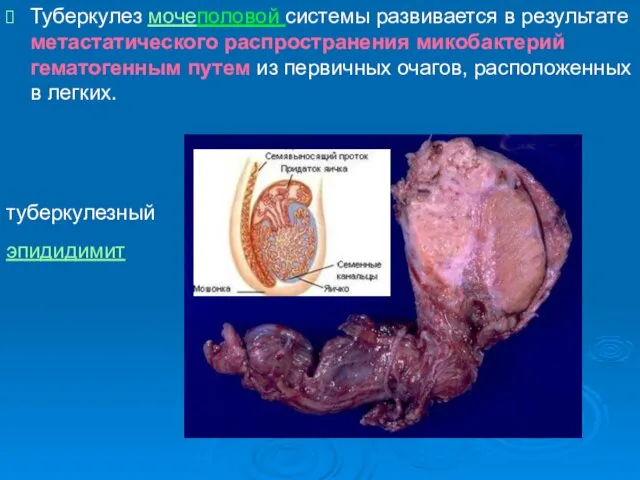 Туберкулез мочеполовой системы развивается в результате метастатического распространения микобактерий гематогенным путем