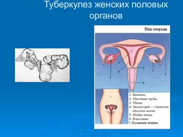 Туберкулез женских половых органов