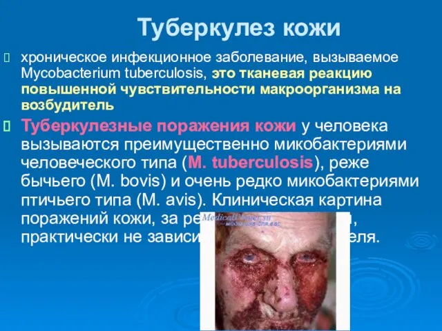 Туберкулез кожи хроническое инфекционное заболевание, вызываемое Mycobacterium tuberculosis, это тканевая реакцию