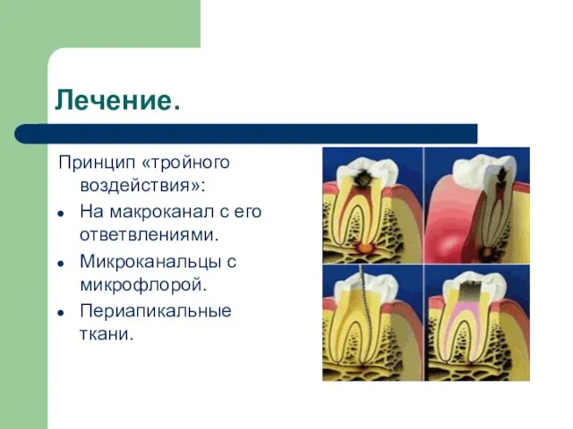 Лечение. Принцип «тройного воздействия»: На макроканал с его ответвлениями. Микроканальцы с микрофлорой. Периапикальные ткани.