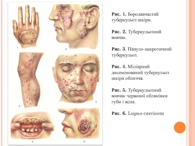 Рис. 1. Бородавчастий туберкульоз шкіри. Рис. 2. Туберкульозний вовчак. Рис. 3.