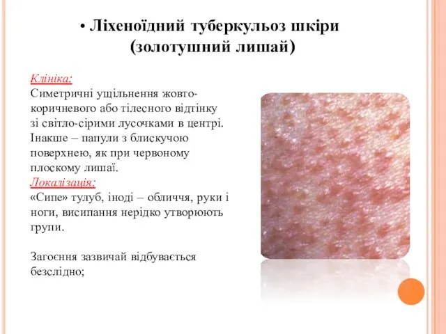 Ліхеноїдний туберкульоз шкіри (золотушний лишай) Клініка: Симетричні ущільнення жовто-коричневого або тілесного