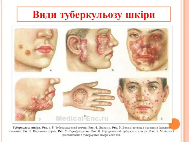 Види туберкульозу шкіри Туберкульоз шкіри. Рис. 4-6. Туберкульозний вовчак. Рис. 4.