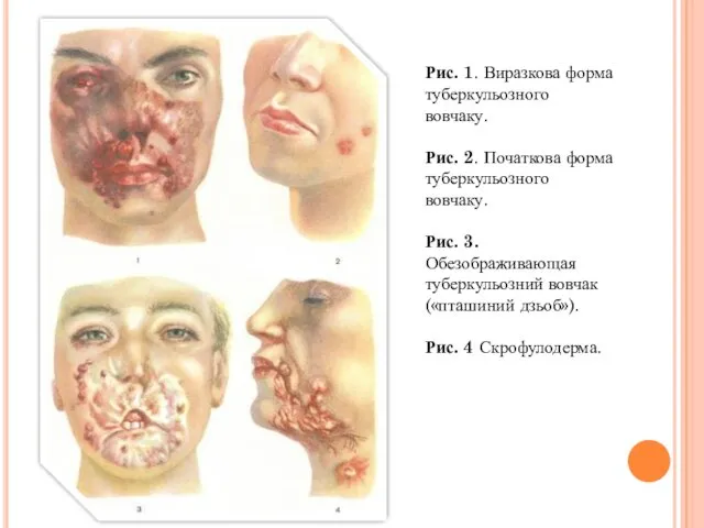 Рис. 1. Виразкова форма туберкульозного вовчаку. Рис. 2. Початкова форма туберкульозного