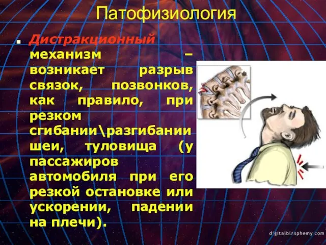 Патофизиология Дистракционный механизм – возникает разрыв связок, позвонков, как правило, при