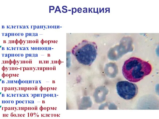 PAS-реакция в клетках гранулоци-тарного ряда – в диффузной форме в клетках