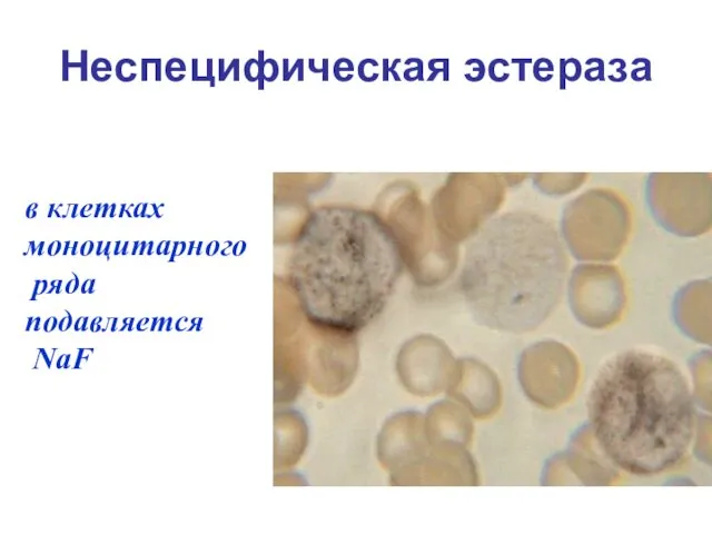 Неспецифическая эстераза в клетках моноцитарного ряда подавляется NaF