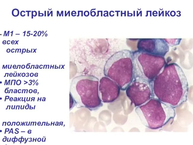 Острый миелобластный лейкоз М1 – 15-20% всех острых миелобластных лейкозов МПО