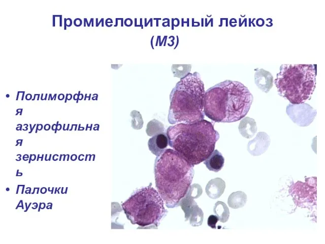 Промиелоцитарный лейкоз (М3) Полиморфная азурофильная зернистость Палочки Ауэра
