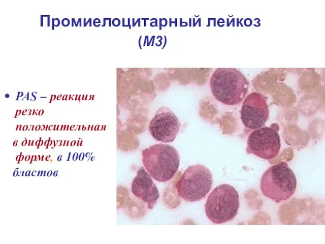 Промиелоцитарный лейкоз (М3) РАS – реакция резко положительная в диффузной форме, в 100% бластов