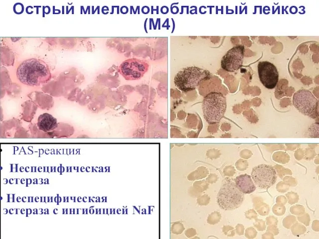 Острый миеломонобластный лейкоз (М4) PAS-реакция Неспецифическая эстераза Неспецифическая эстераза с ингибицией NaF