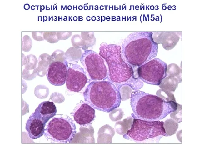 Острый монобластный лейкоз без признаков созревания (М5а)