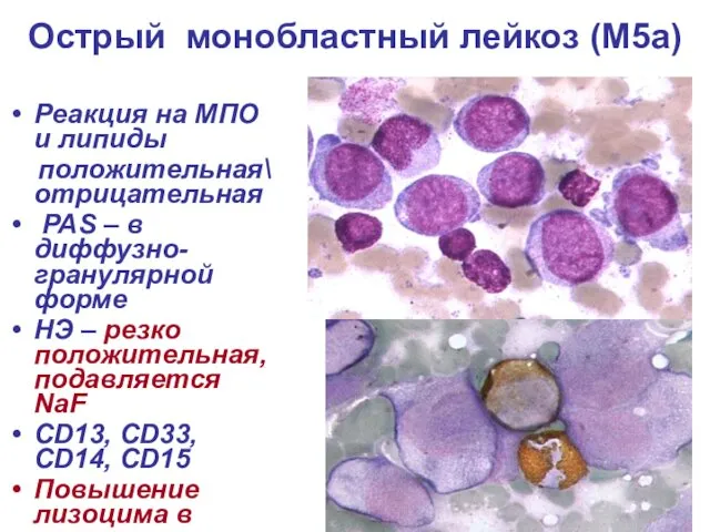 Острый монобластный лейкоз (М5а) Реакция на МПО и липиды положительная\ отрицательная