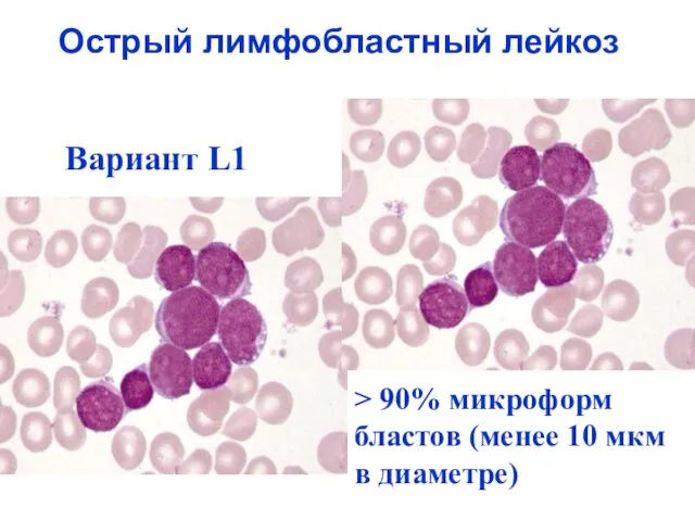 Острый лимфобластный лейкоз Вариант L1 > 90% микроформ бластов (менее 10 мкм в диаметре)