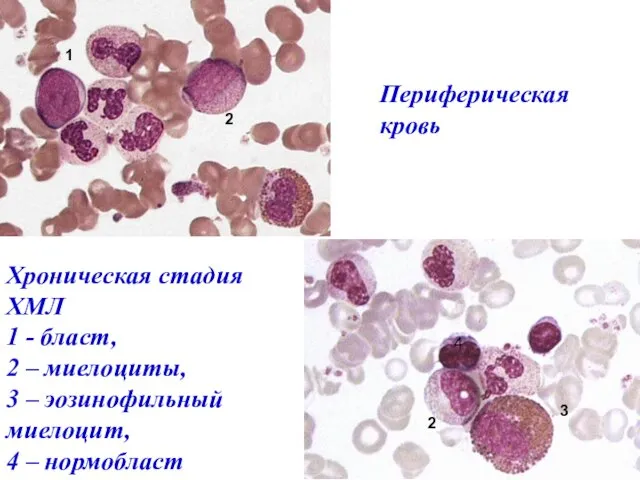 Хроническая стадия ХМЛ 1 - бласт, 2 – миелоциты, 3 –