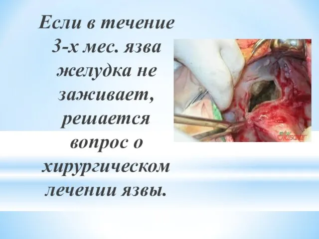 Если в течение 3-х мес. язва желудка не заживает, решается вопрос о хирургическом лечении язвы.