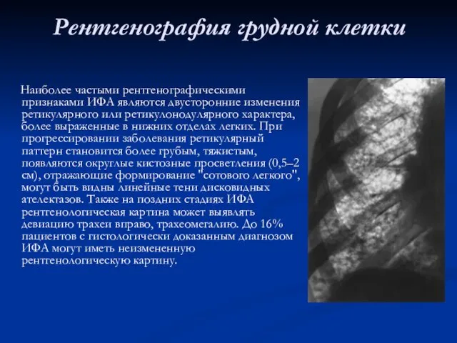 Рентгенография грудной клетки Наиболее частыми рентгенографическими признаками ИФА являются двусторонние изменения
