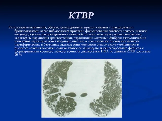 КТВР Ретикулярные изменения, обычно двухсторонние, отчасти связаны с тракционными бронхоэктазами; часто