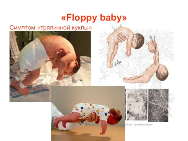 «Floppy baby» Симптом «тряпичной куклы»