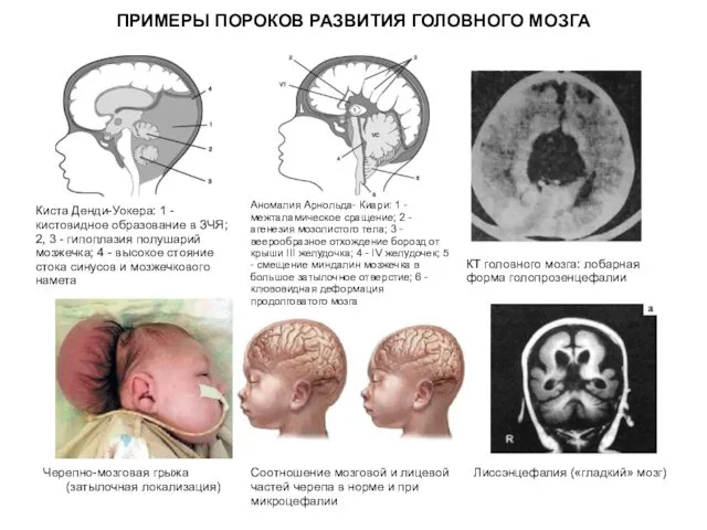 ПРИМЕРЫ ПОРОКОВ РАЗВИТИЯ ГОЛОВНОГО МОЗГА Киста Денди-Уокера: 1 - кистовидное образование