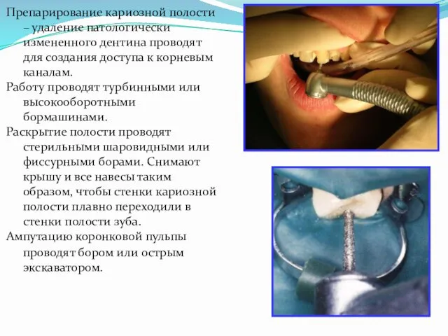 Препарирование кариозной полости – удаление патологически измененного дентина проводят для создания