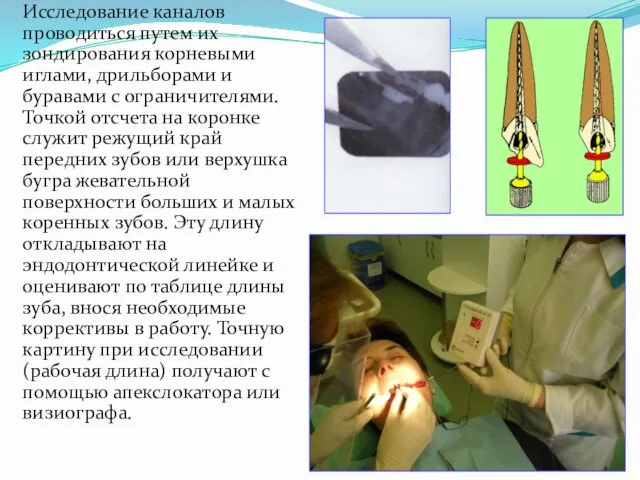 Исследование каналов проводиться путем их зондирования корневыми иглами, дрильборами и буравами