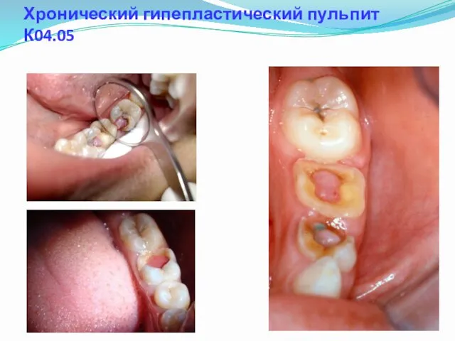 Хронический гипепластический пульпит К04.05