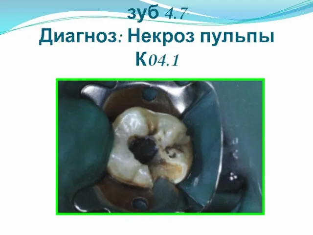 Клинический случай зуб 4.7 Диагноз: Некроз пульпы К04.1