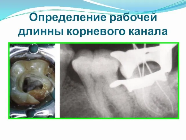 Определение рабочей длинны корневого канала