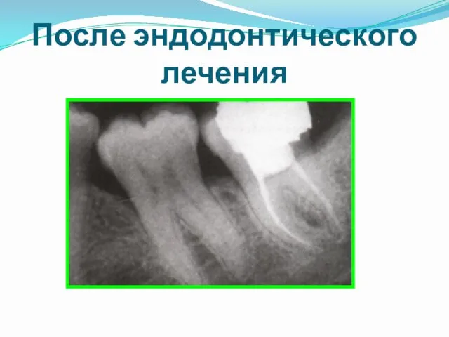 После эндодонтического лечения