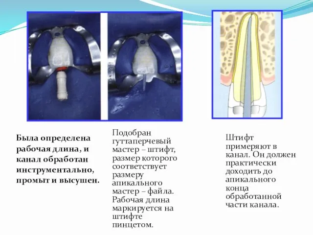 Была определена рабочая длина, и канал обработан инструментально, промыт и высушен.