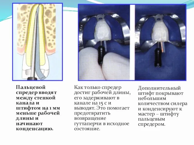 Пальцевой спредер вводят между стенкой канала и штифтом на 1 мм