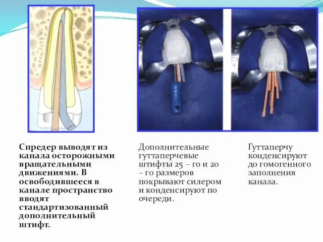 Спредер выводят из канала осторожными вращательными движениями. В освободившееся в канале