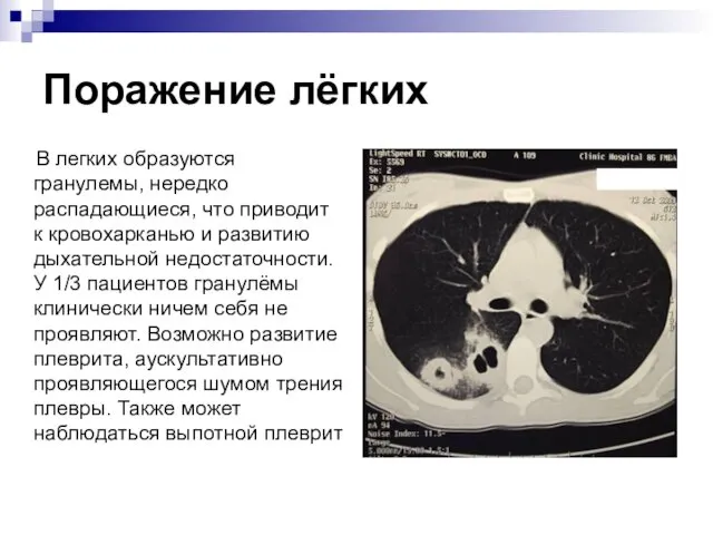 Поражение лёгких В легких образуются гранулемы, нередко распадающиеся, что приводит к