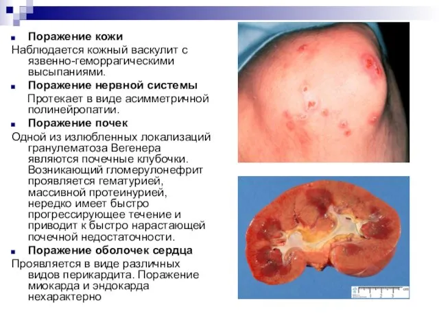 Поражение кожи Наблюдается кожный васкулит с язвенно-геморрагическими высыпаниями. Поражение нервной системы