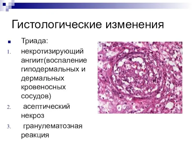 Гистологические изменения Триада: некротизирующий ангиит(воспаление гиподермальных и дермальных кровеносных сосудов) асептический некроз гранулематозная реакция