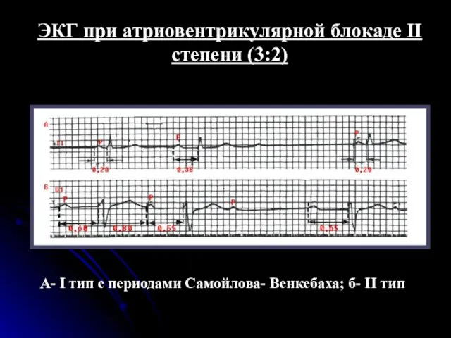 ЭКГ при атриовентрикулярной блокаде II степени (3:2) А- I тип с