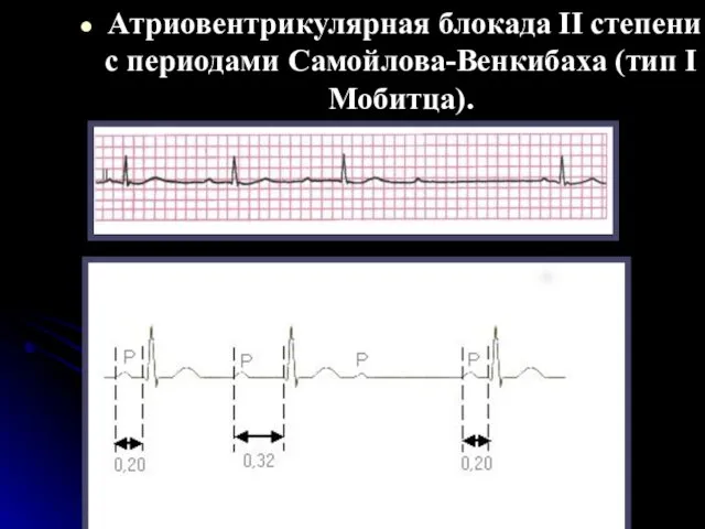 Атриовентрикулярная блокада II степени с периодами Самойлова-Венкибаха (тип I Мобитца).