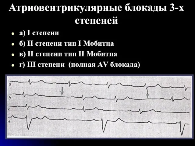 Атриовентрикулярные блокады 3-х степеней а) I степени б) II степени тип