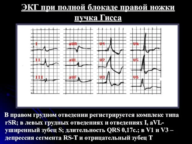 ЭКГ при полной блокаде правой ножки пучка Гисса В правом грудном