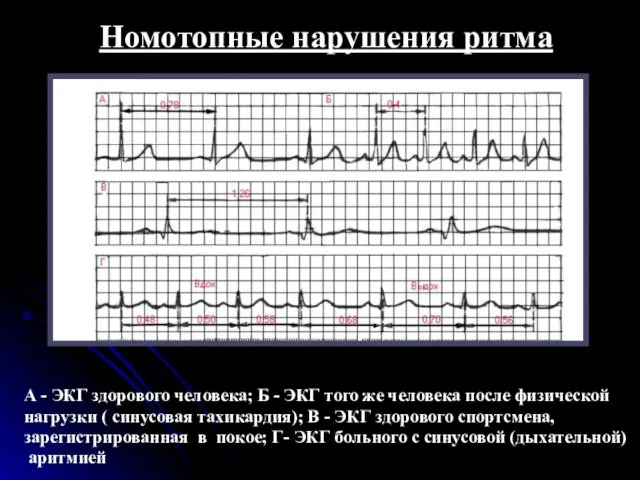 Номотопные нарушения ритма А - ЭКГ здорового человека; Б - ЭКГ