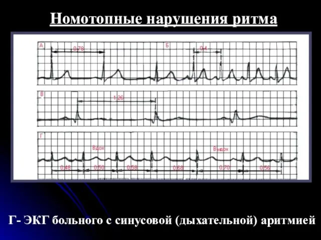 Номотопные нарушения ритма Г- ЭКГ больного с синусовой (дыхательной) аритмией