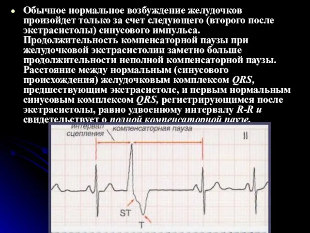 Обычное нормальное возбуждение желудочков произойдет только за счет следующего (второго после