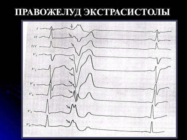 ПРАВОЖЕЛУД ЭКСТРАСИСТОЛЫ